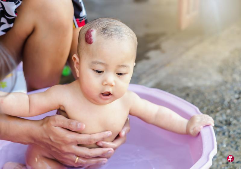 医生必须根据宝宝胎记的大小、数量和位置，对其做详细评估。（iStock图片）