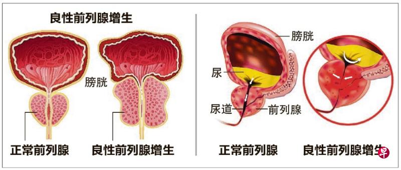 正常前列腺与良性前列腺增生的差别。（iStock图片）