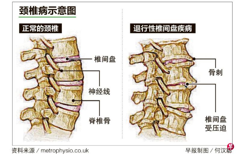 退行性椎间盘疾病属于颈椎病的一种，症状包括椎间盘受压迫，以及骨刺形成。